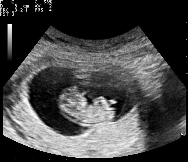Pregnancy_ultrasound_110316153736_1538380.jpg